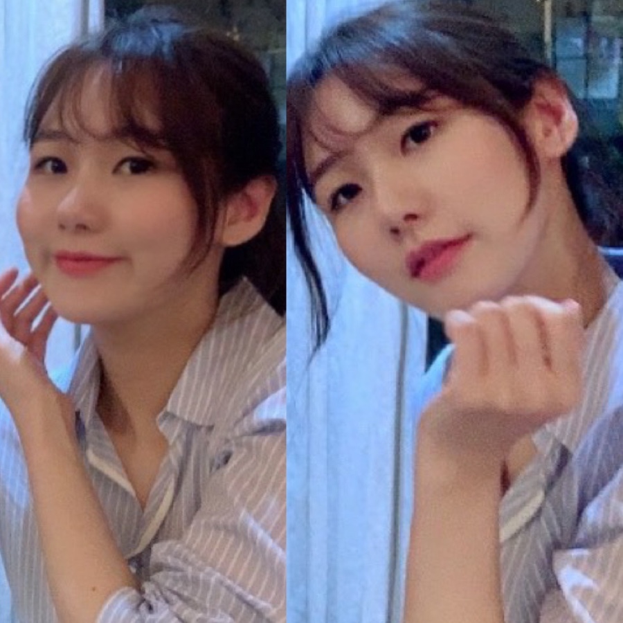 코조각주사 콧볼축소 효과 16