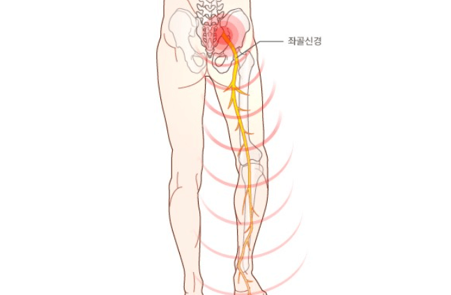 좌골신경 다발