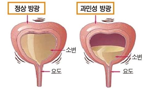 과민성 방광의 증상