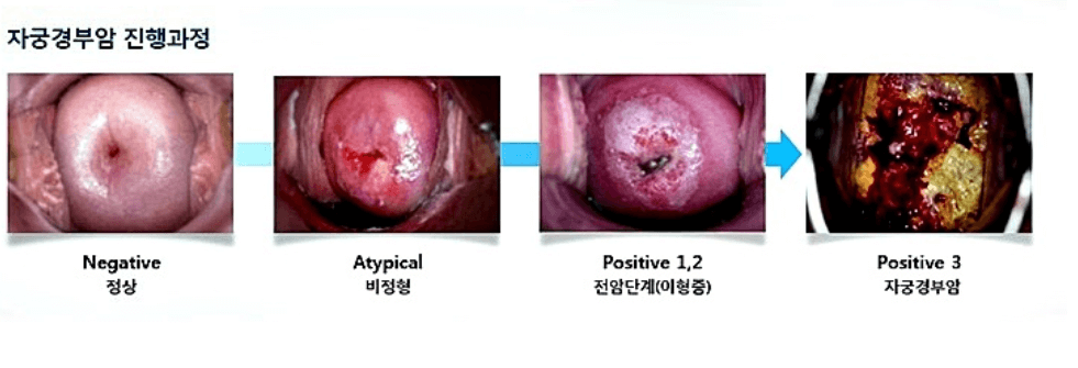 자궁경부암 검사방법 자궁경부암 검사비용