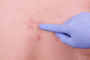 대상포진-후유증