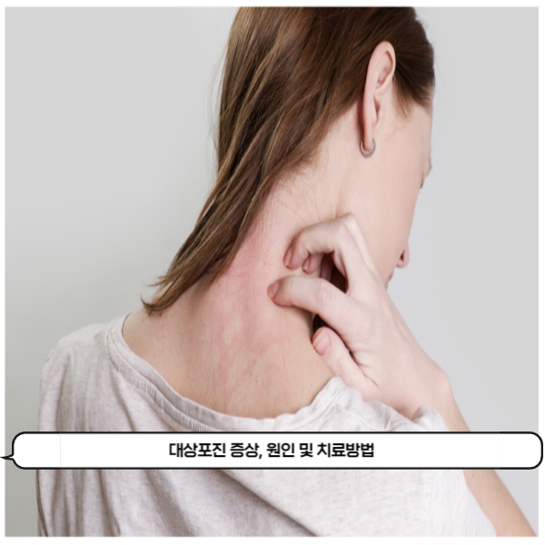  피부에 붉은 반점이 생겼다면 대상포진을 의심해봐야 할때! 대상포진의 증상, 원인 및 치료방법
