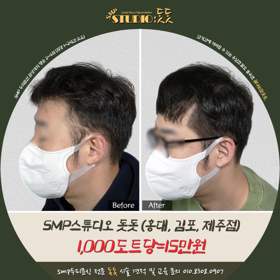 남성 옆머리 탈모 두피문신으로 극복