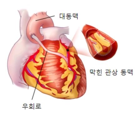 협심증 증상