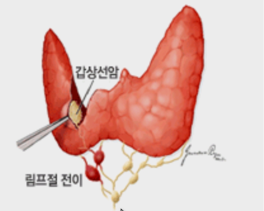 갑상선암