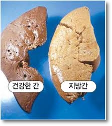  지방간 원인과 종류, 좋은음식들 소개