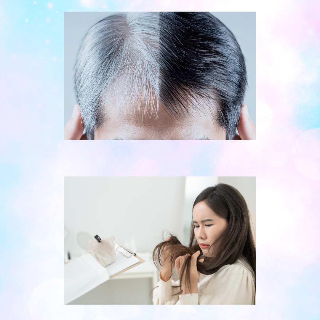 비오틴 관련 탈모 사진