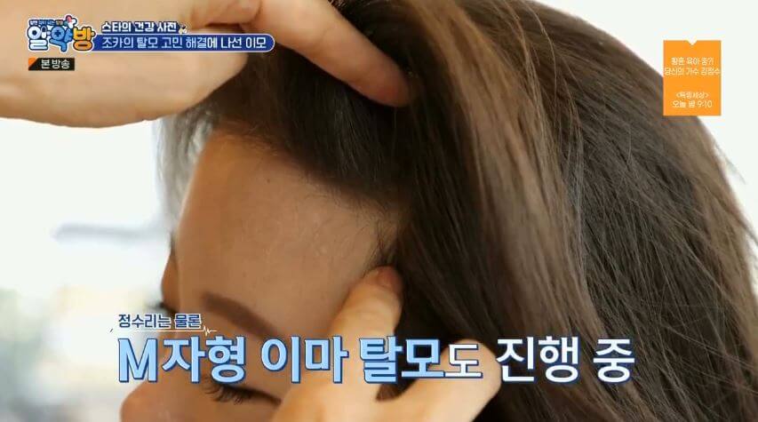 M자형 이마 탈모 진행중