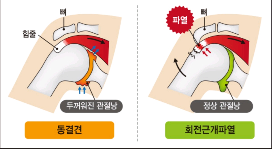  오십견 증상과 치료 방법