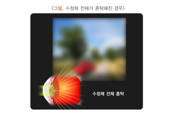 백내장