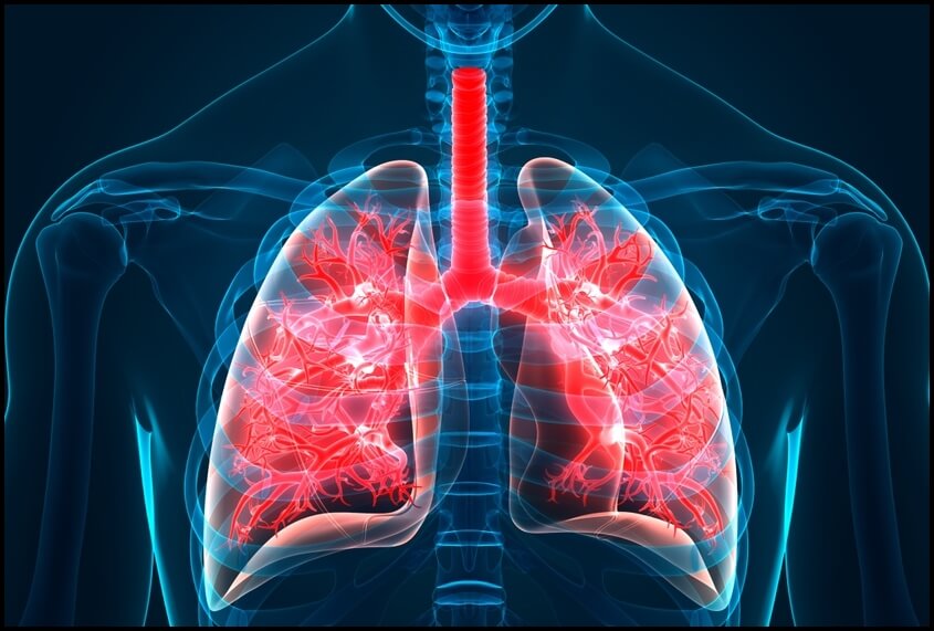 폐섬유증