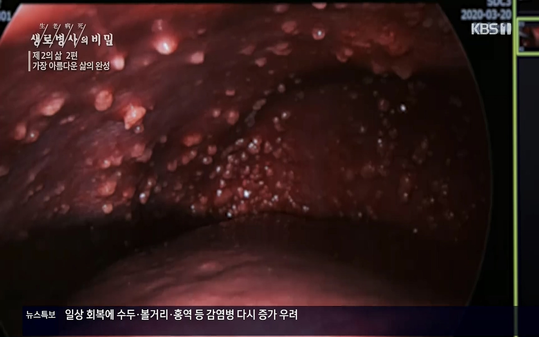 생로병사의 비밀.E820.220511p.H264-F1RST.mp4_20220512_192537.366.jpg