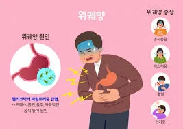 위궤양 증상