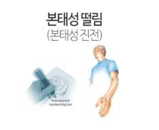 본태성 진전(수전증) 증상