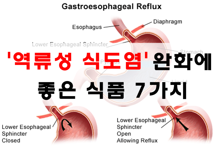  역류성식도염에 좋은음식 건강하세요