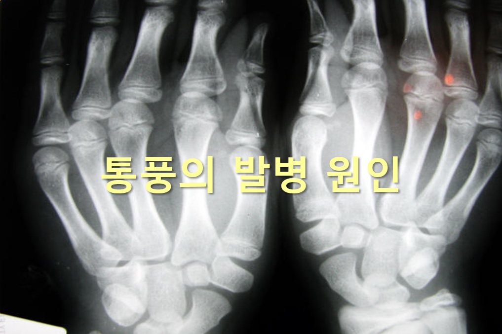 통풍이 오는 이유와 통풍에 좋은 약초