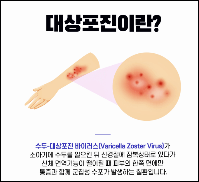  대상포진 초기증상 전염성 치료법 등 총정리
