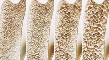  골다공증(osteoporosis)타파하기! 뼈건강을 위한 황금 정보 10가지