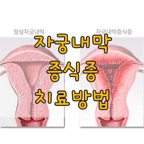 자궁내막증식증치료방법&#44; 원인 치료방법과 재발방지의 모든것!