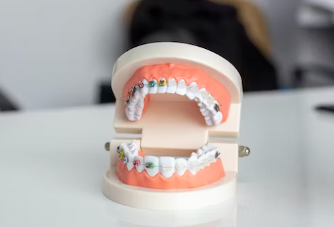 치과의-브릿지-모형