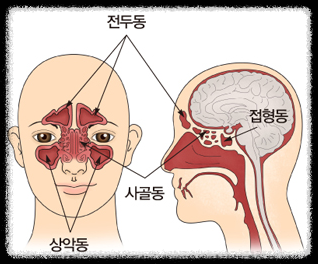 부비동염 치료