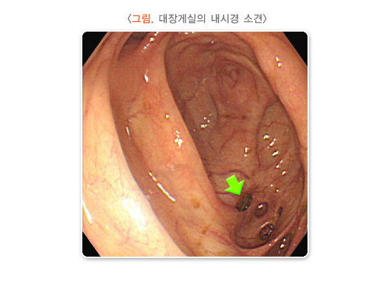 게실염 증상 치료방법