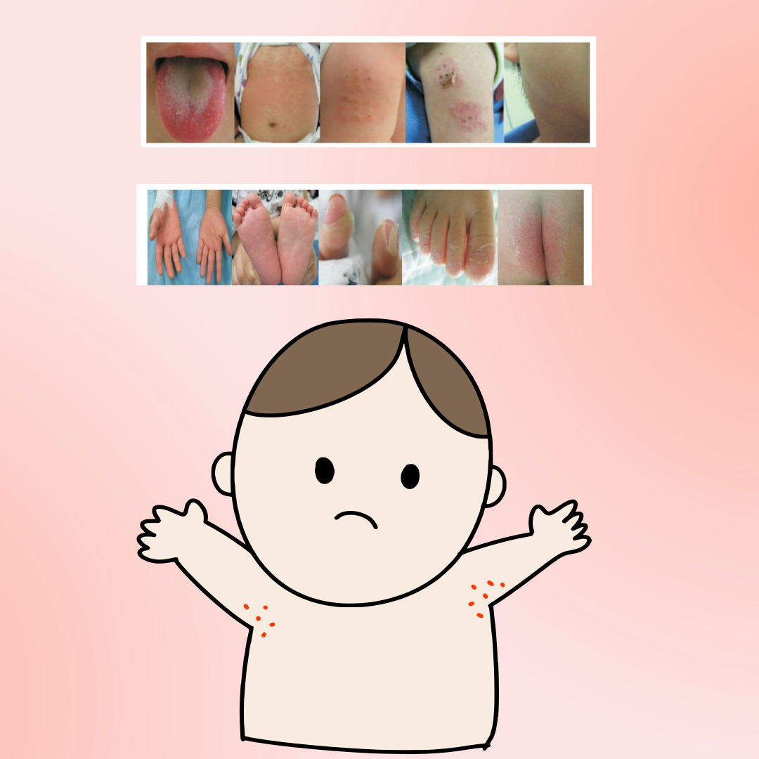 가와사키병 증상 사진