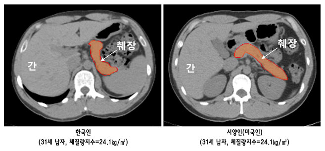 한국인 췌장크기