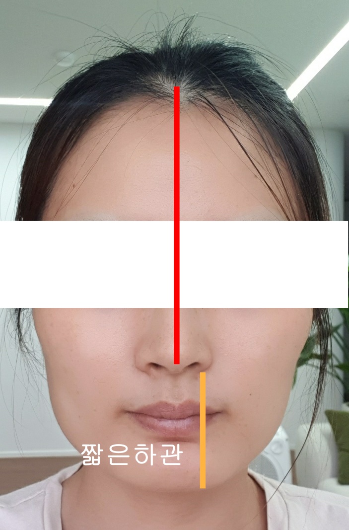deep bite - face shape