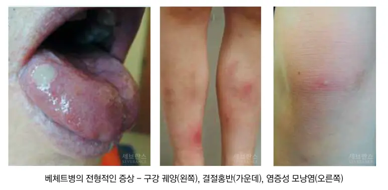 베체트 병의 전형적인 증상의 모습
