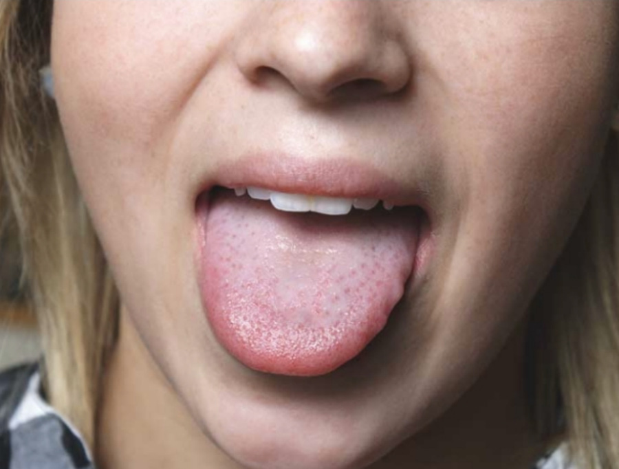 혀의 양쪽 옆에 이빨에 물린 자국인 치흔을 가지고 있는 여성이 혀를 내밀고 있는 것을 확대하여 찍은 사진