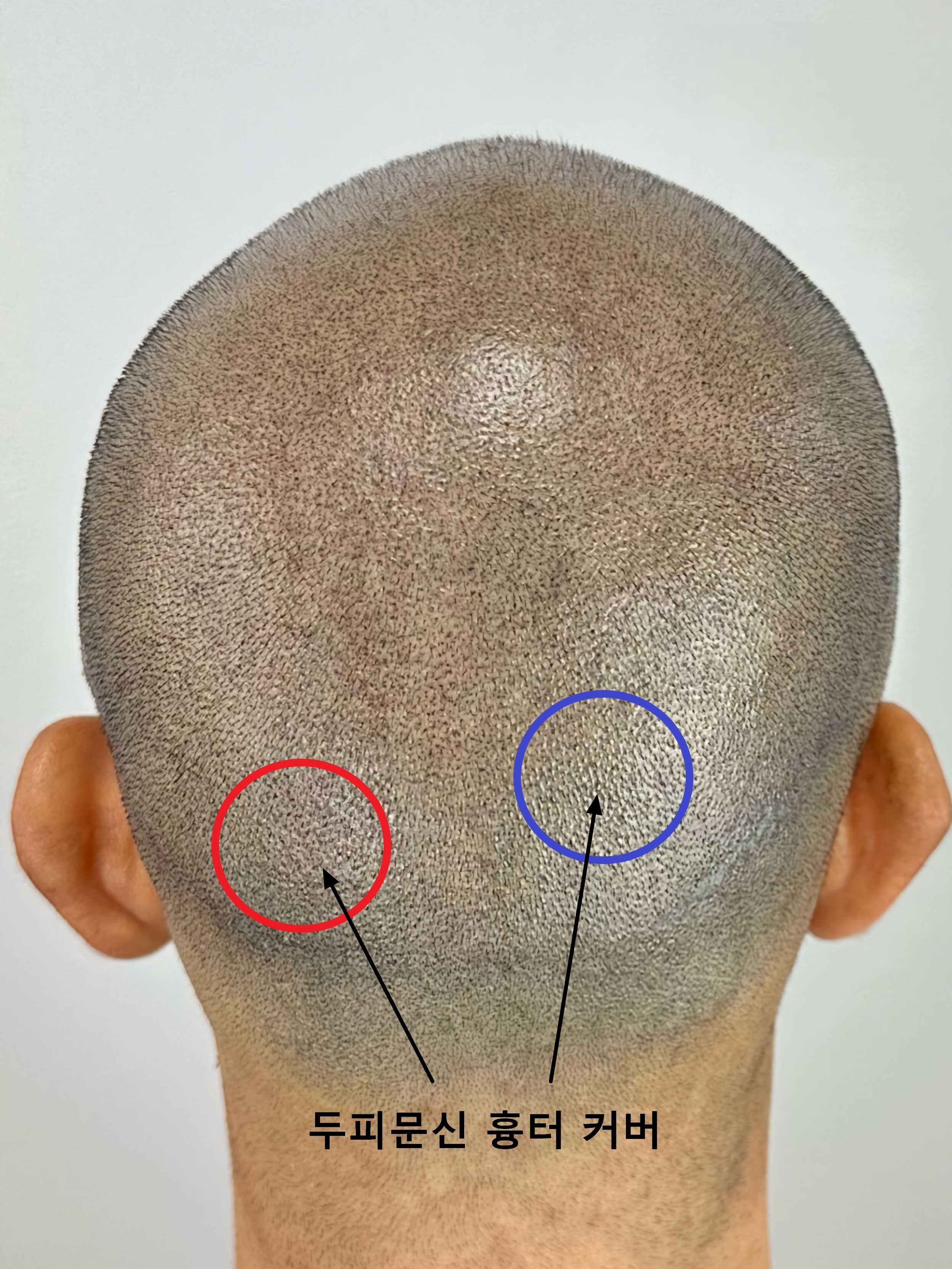 모발이식 흉터를 두피문신으로 커버한 모습