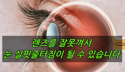 렌즈 눈 실핏줄 터짐