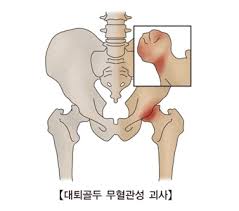 고관절-통증-증상