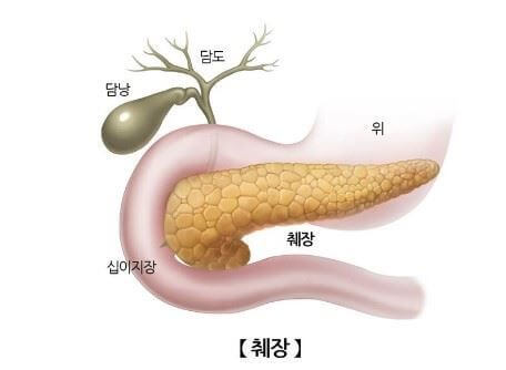 췌장암 초기증상