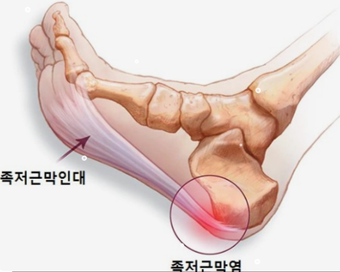 족저근막염