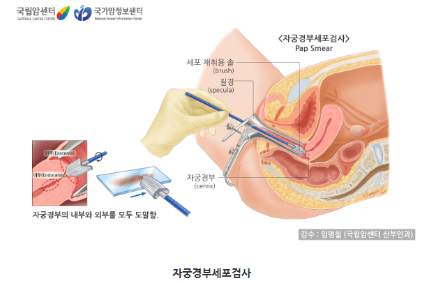 자궁경부암 원인,증상,진단,예방