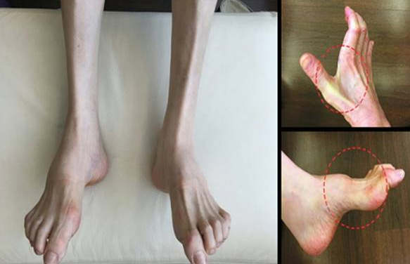 Charcomaritus 질병