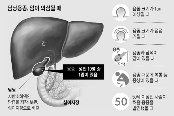 쓸개암에 대한 자료