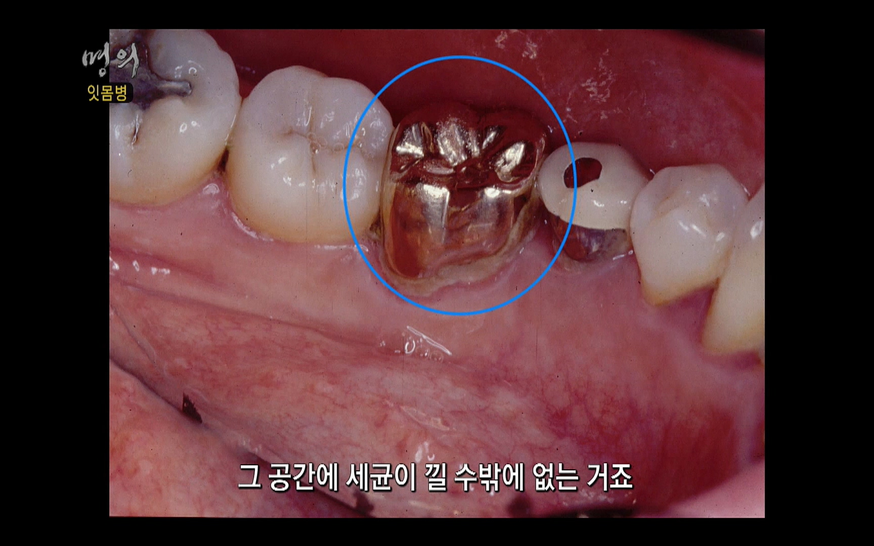 EBS 명의 헬스케어 - TV - 교육의 중심 EBS2015년 1월 16일 (금) 밤 9시 50분, EBS1.mp4_20220505_150404.649.jpg
