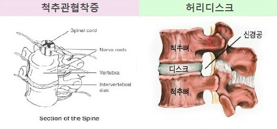 척추관협착증과 허리디스크의 차이점