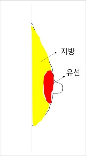  여유증수술 무조건 성공하는 법