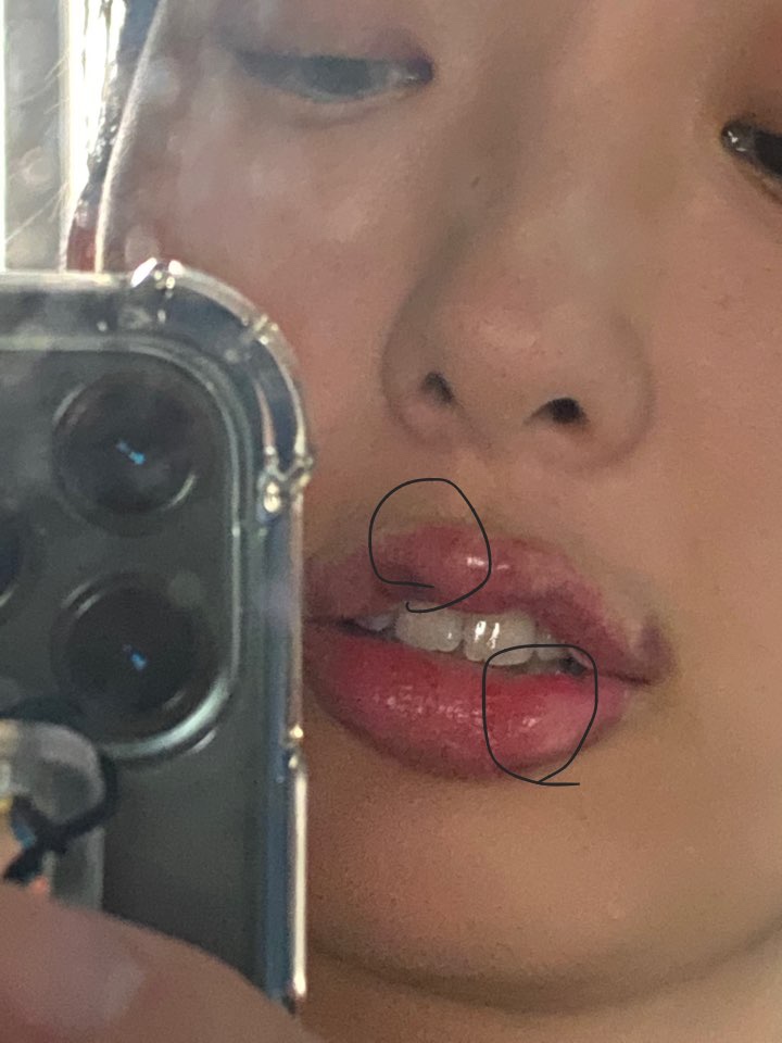 입술 보톡스 부작용 대전 입술필러+입꼬리보톡스 내돈내산 12