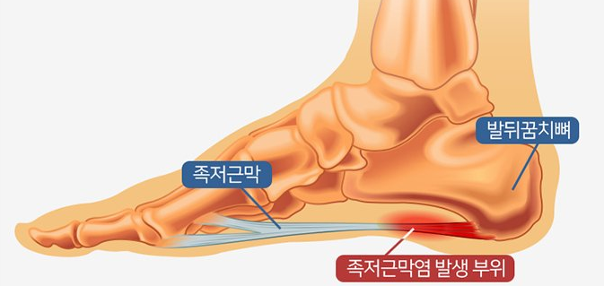  발바닥통증 원인 및 치료방법
