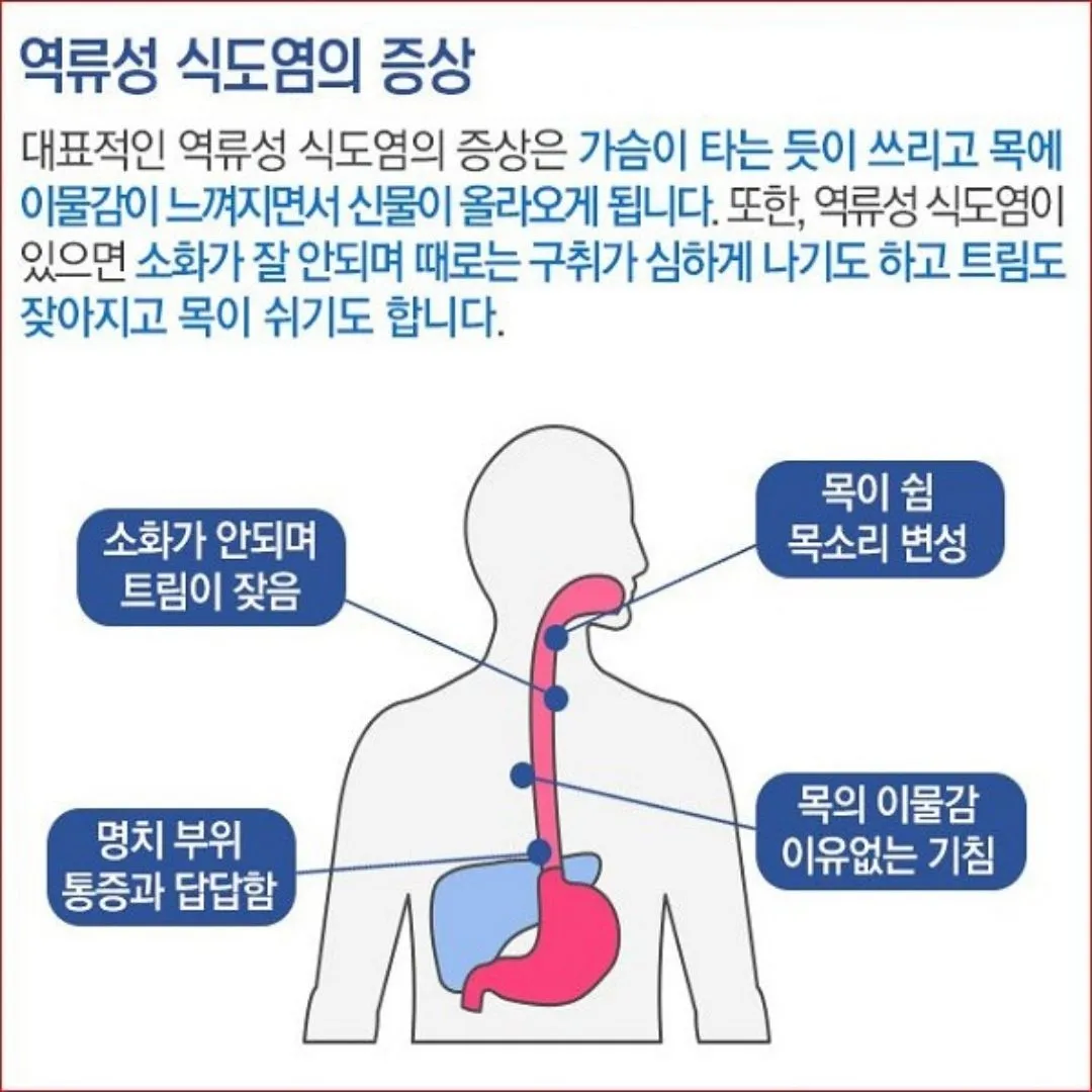 역류성 식도염 증상과 자연치료 방법