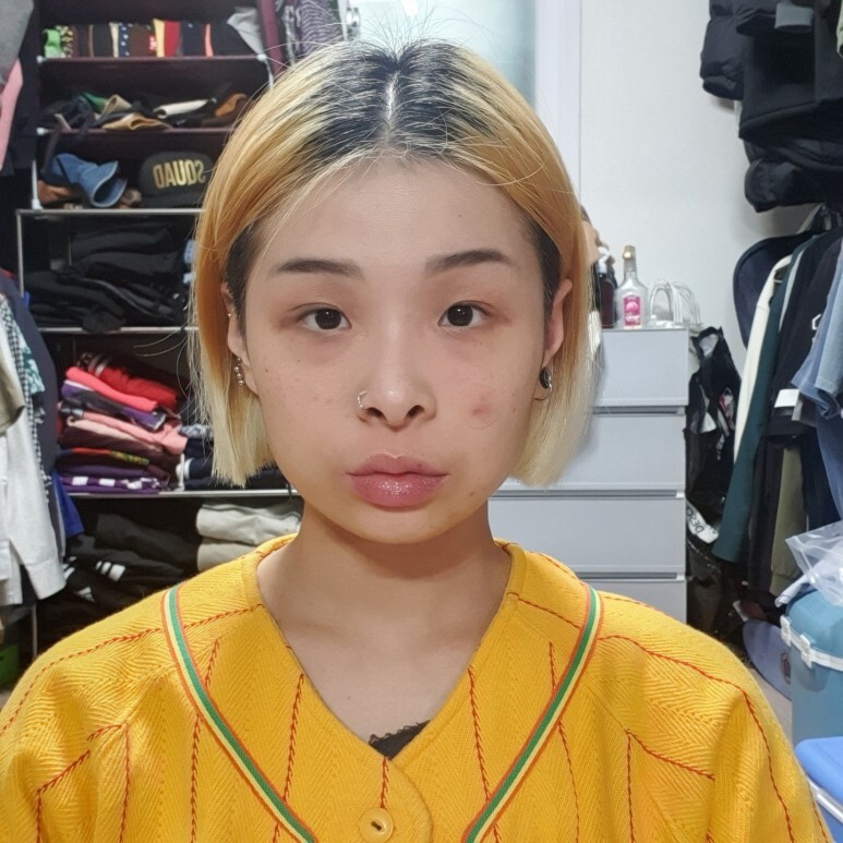  첫성형 으로 고급스러워진 미모가 와우~ ㄷㄷㄷ [ 첫성형-눈,코성형,풀페이스 지방이식 ] 댄서 (dancer )의 성형vlog - 아름답tv-