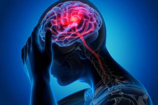 뇌출혈의 원인과 위험 요인