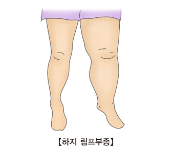 암 치료 후 발생하는 하지림프부종 1