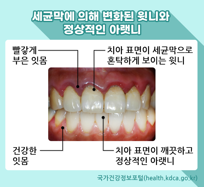 임플란트 의료보험적용 총정리