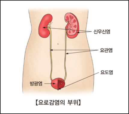 신우신염 증상 및 예방법